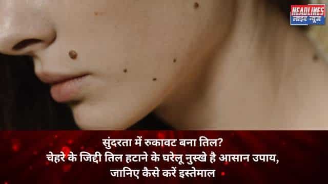 LASER SURGERY के बिना चेहरे के जिद्दी तिल हटाने के घरेलू नुस्खे है आसान उपाय, जानिए कैसे करें इस्तेमाल 2025 !